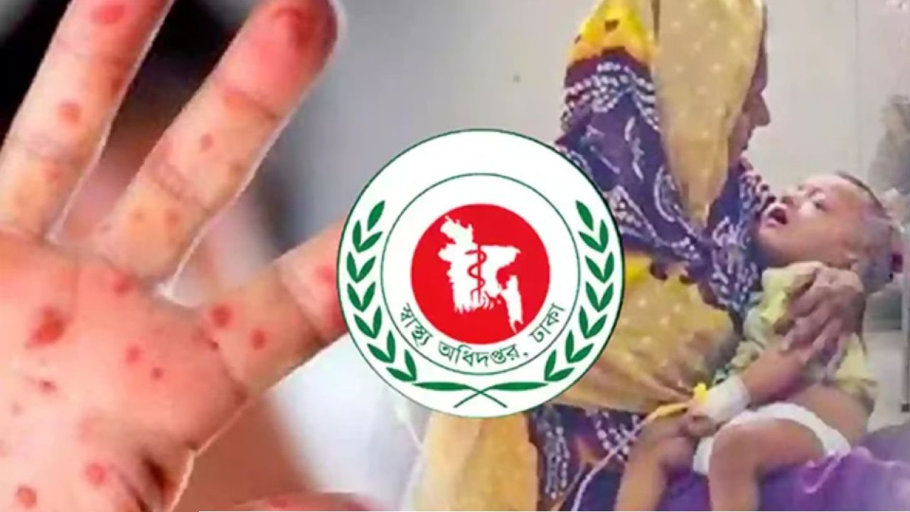 সারা দেশে হাম ও উপসর্গে মৃত্যু ছাড়াল ৫০০